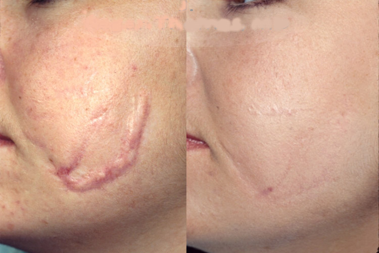 laser per cicatrici laser per cicatrici